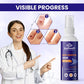 Wart Remover Cream